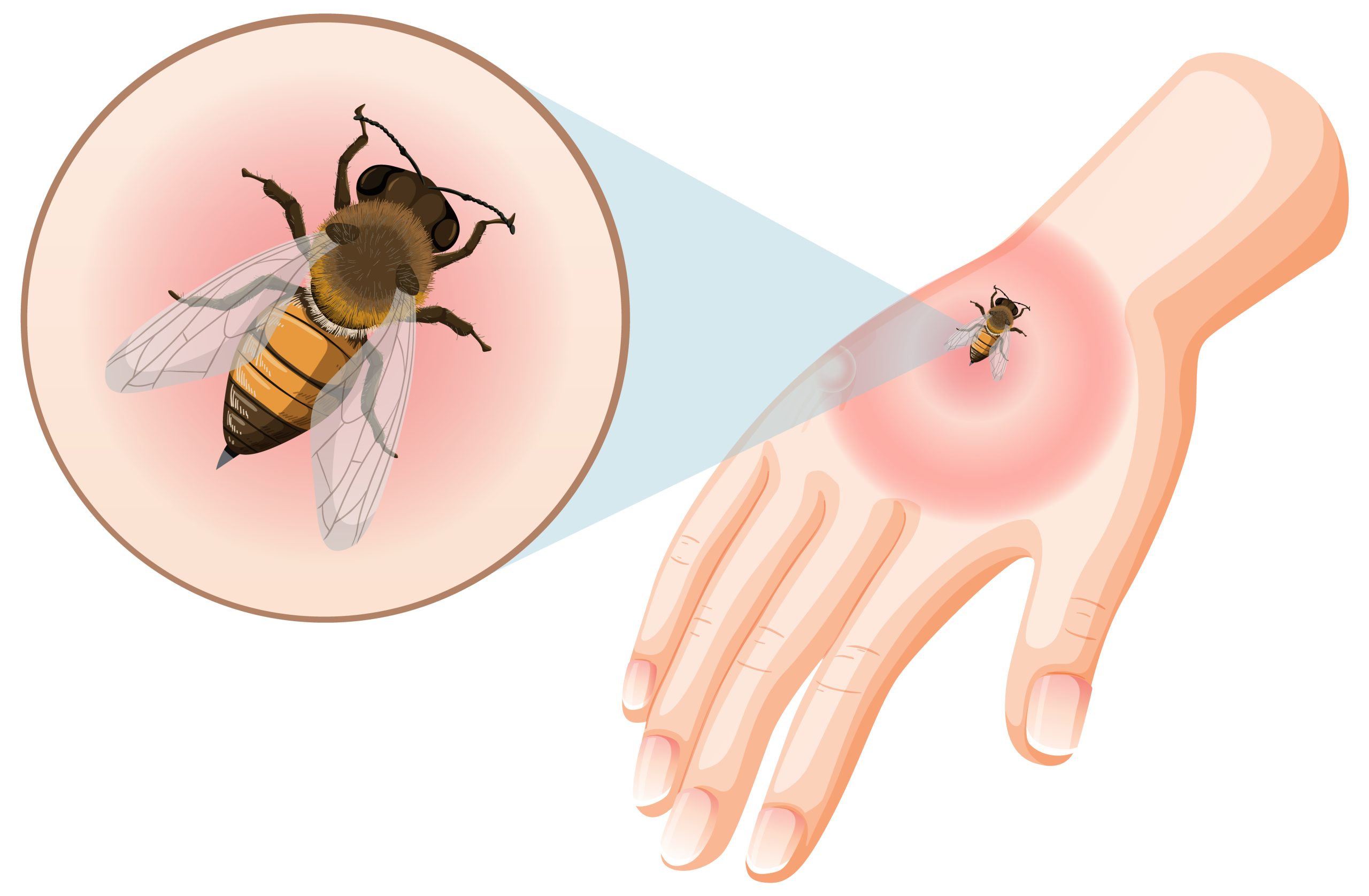 Tick Pest Control Columbus Ohio 8 Bee bites sting on skin